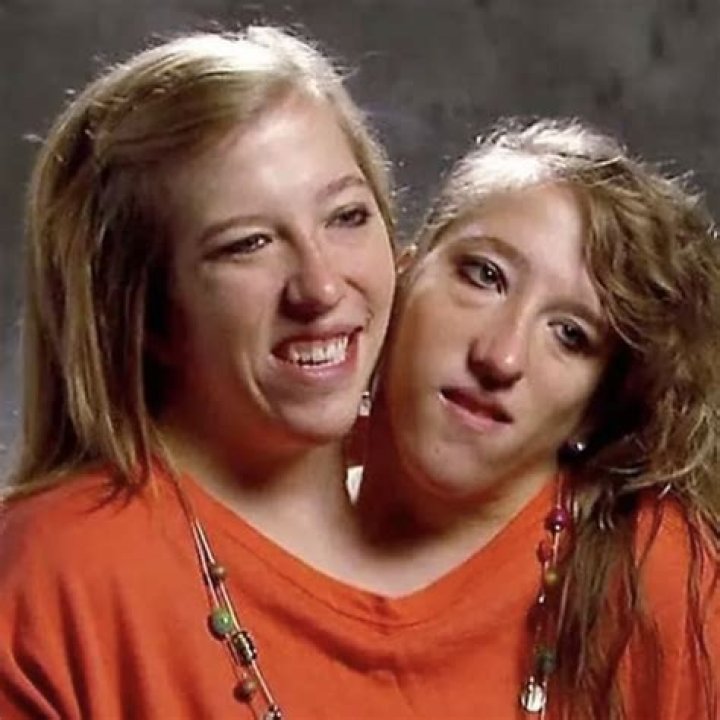 Understanding the Lives and Legacy of Abby and Brittany Hensel: Conjoined Twins and Their Journey